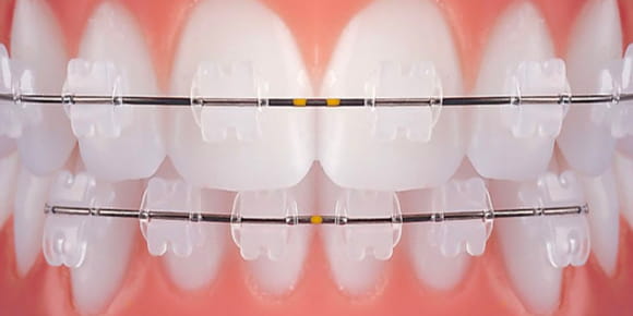 Зубы с самолигирующиемися брекетами
