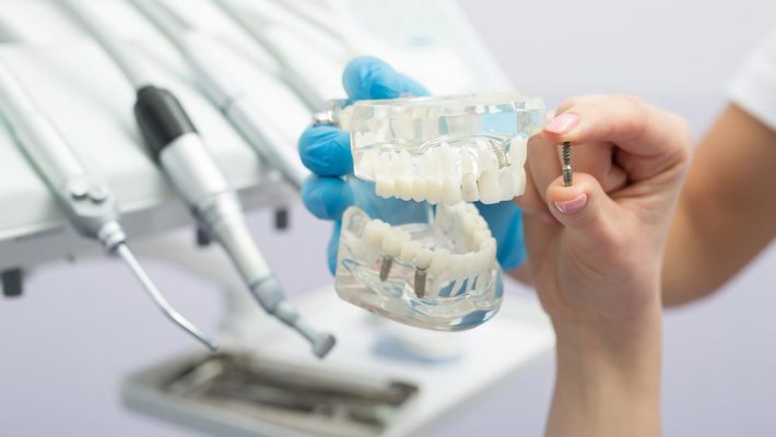 Имплантация зубов без разрезов
