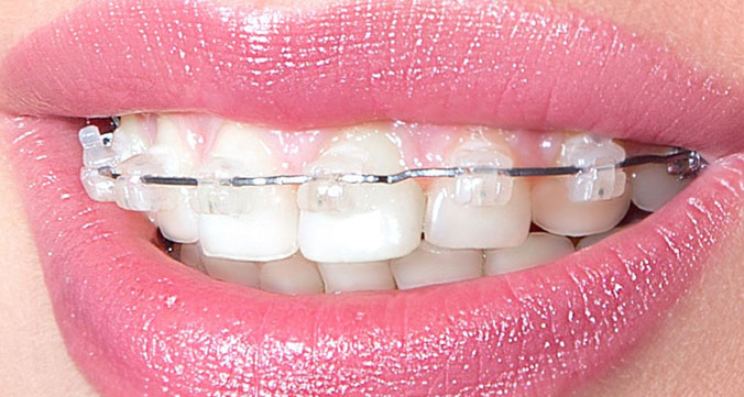 Зубы с керамическими брекетами