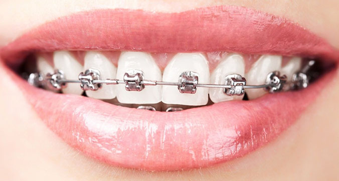 Зубы с металлическими брекетами